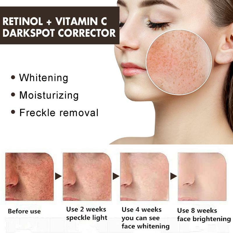 Creme removedor de manchas pretas, hidratante e clareamento, cuidados com a pele, visivelmente, reduzir a escuridão, manchas no rosto