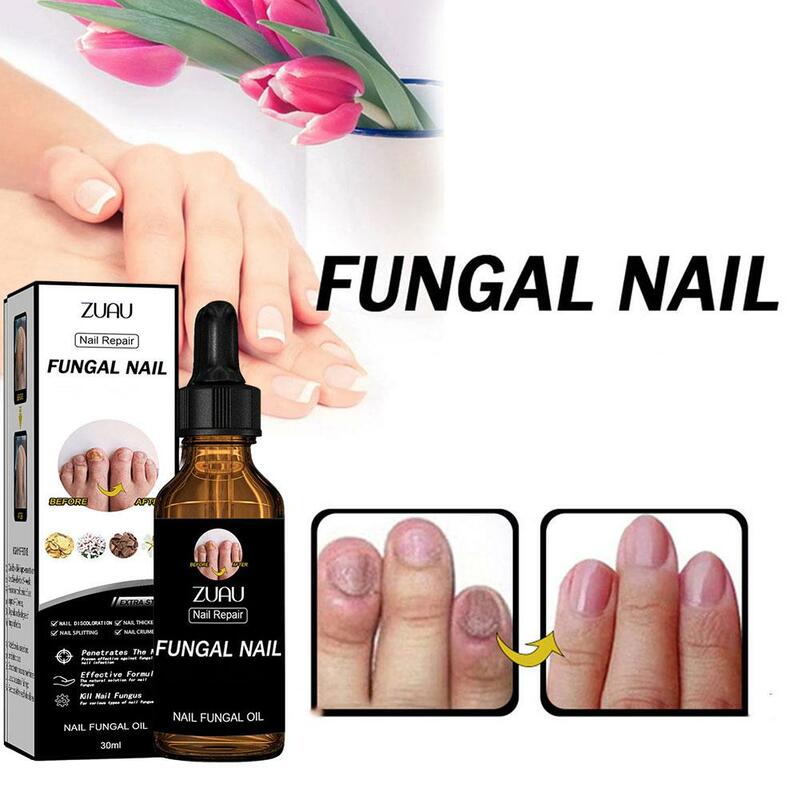Nail Fungus Treatment Essence Anti Infection Paronychia Onychomycosis Repair Foot Nourishing Hand Fungal 30ml Care Removal F5U1