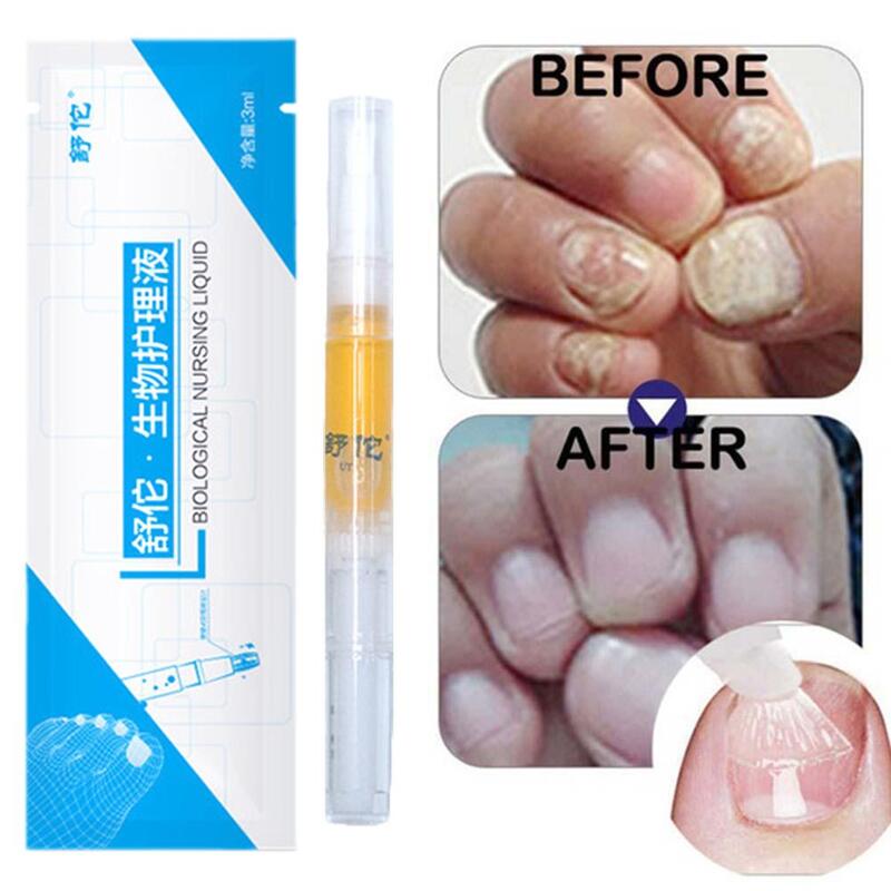 Bolígrafo de puntero láser para reparación de uñas, indolora, elimina hongos en las uñas, puntero