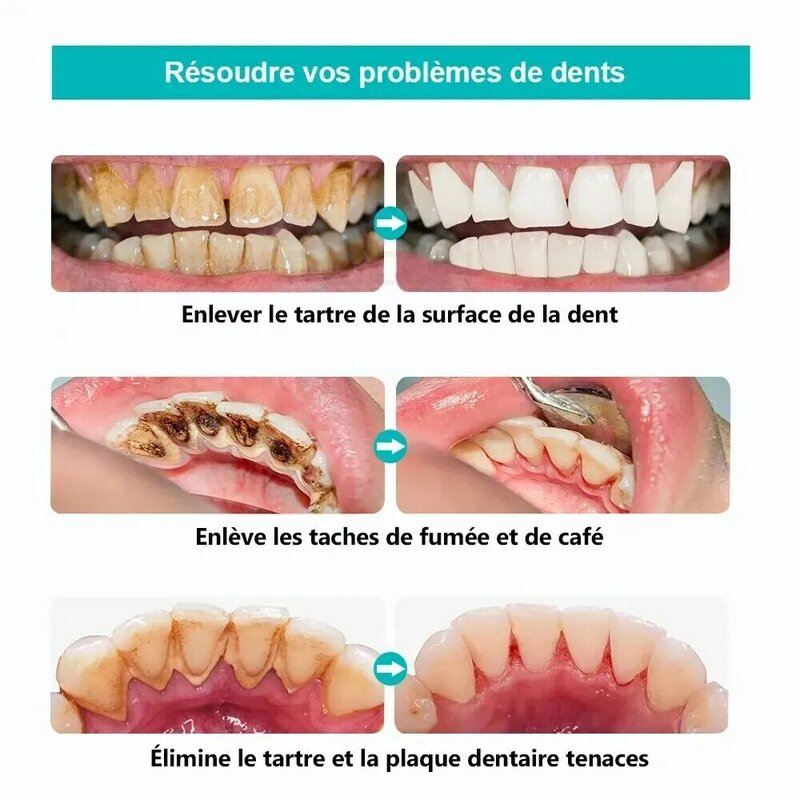 Raspador Dental ultrasónico, limpiador de dientes, eliminación de piedra Dental, removedor de placa sónica eléctrica para manchas de dientes, sarro