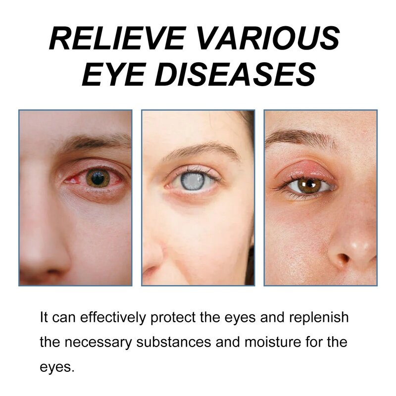 Remoção de catarata Eye Drop, Melhorar a visão loira, Restaurar a visão, Aliviar a infecção do globo ocular, Coceira seca, Gota De Tratamento De Olhos Vermelhos