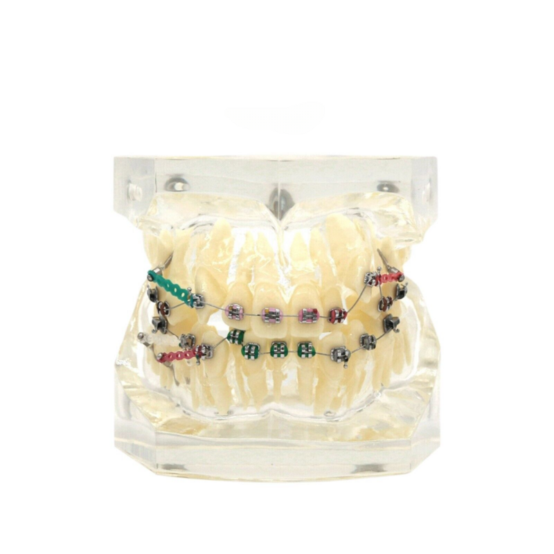 تقويم الأسنان علاج الأسنان نموذج الأسنان مع الأقواس المعدنية قوس الأسلاك العلاقات للإظهار