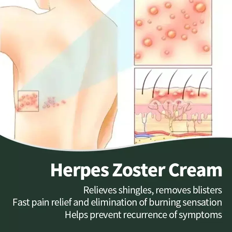Crema Americana para el tratamiento del Herpes Zoster, pomada para curar la piel, medicina para la piel, 20g