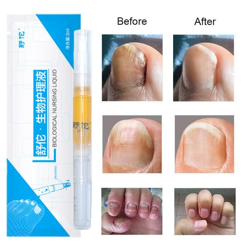 1pcs Nail Paronychia Repair Serum Treats Dry Fungal Attack Rough Nails Discoloration Foot Care Health Supplies hot