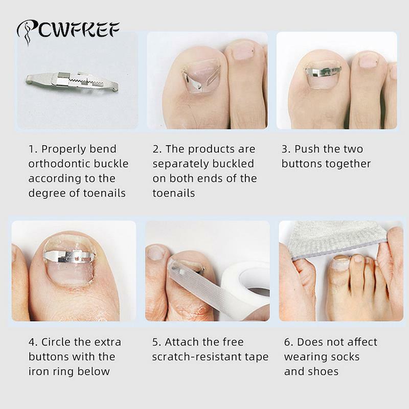 Wrastający paznokieć korektor narzędzia Pedicure odzyskaj osadzić Toe terapia na paznokcie profesjonalne narzędzie do korekcji stóp pielęgnacja stóp