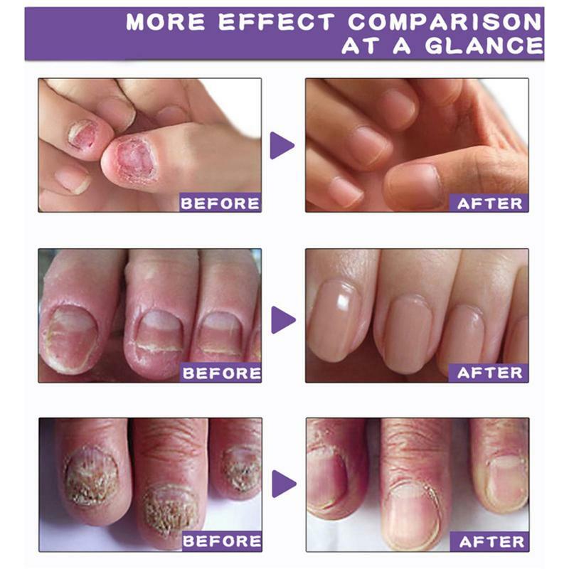 Zehen nagel verstärker und Wachstums formel behandeln und beseitigen Nagel erneuerung Essenz Nagel klärende Nagel lösung für verfärbte Nägel