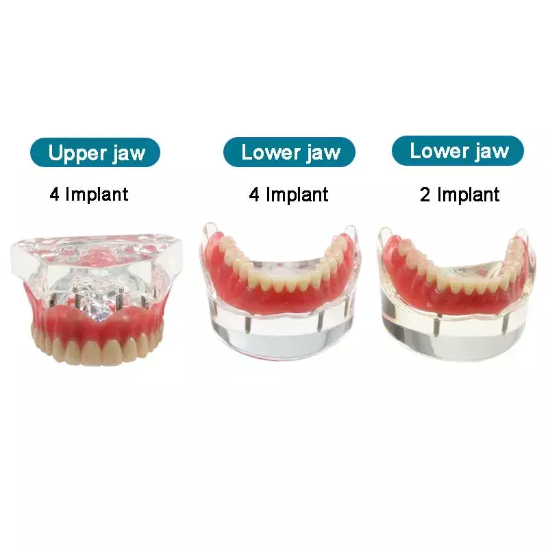 Modelo de dientes dentales con implante de sobredentadura Inferior, modelo de demostración Mandibular, modelo de aprendizaje para estudiantes de dentista
