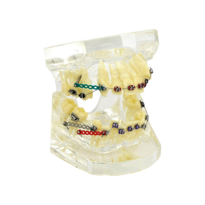 Modelo de dientes de tratamiento de ortodoncia Dental con soportes de Metal, lazos de cables de arco para demostración