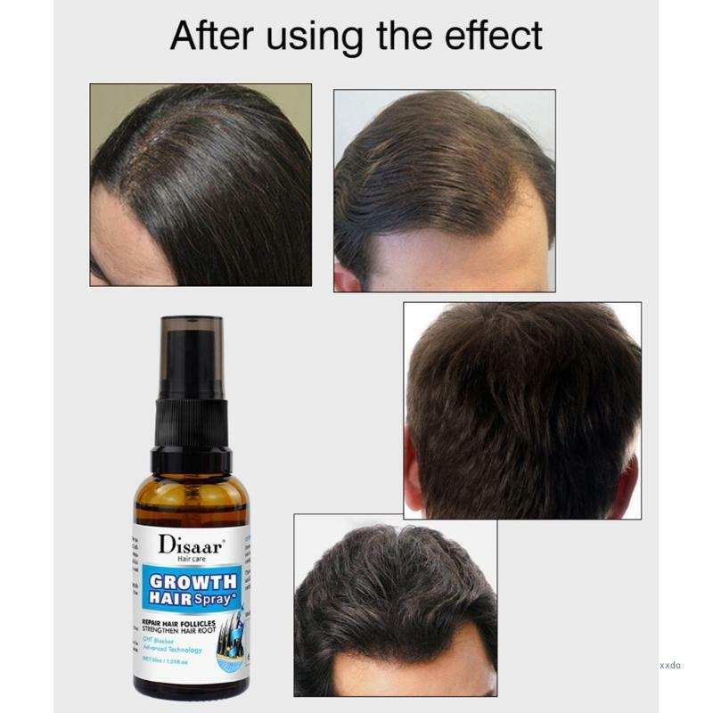 Disaar-aceite esencial para el crecimiento del cabello, productos contra la caída del cabello, crecimiento rápido, suaviza el cuero cabelludo, reparación dañada, 30ml