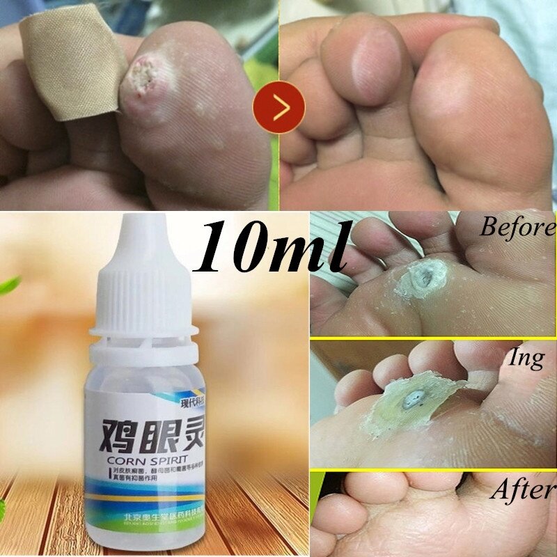 Potente rimozione del mais del piede utile rimozione del callo del piede 10ml Pro