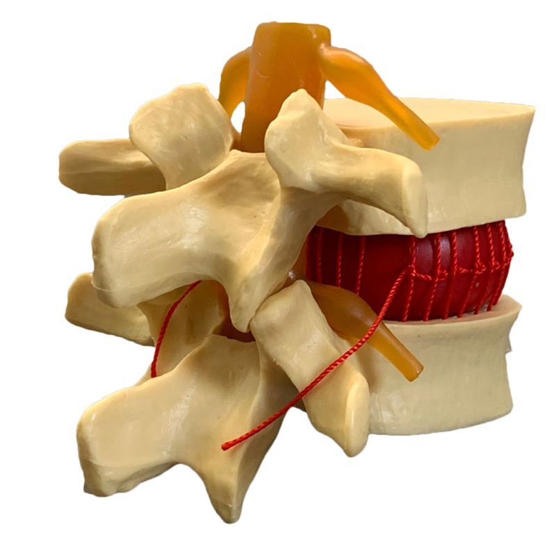 Vértebras Lombares Humanas Anatômicas, Disco Lombar Degenerativo, Herniation Demonstration Model, Modelo de Coluna Humana-Branco, Amarelo