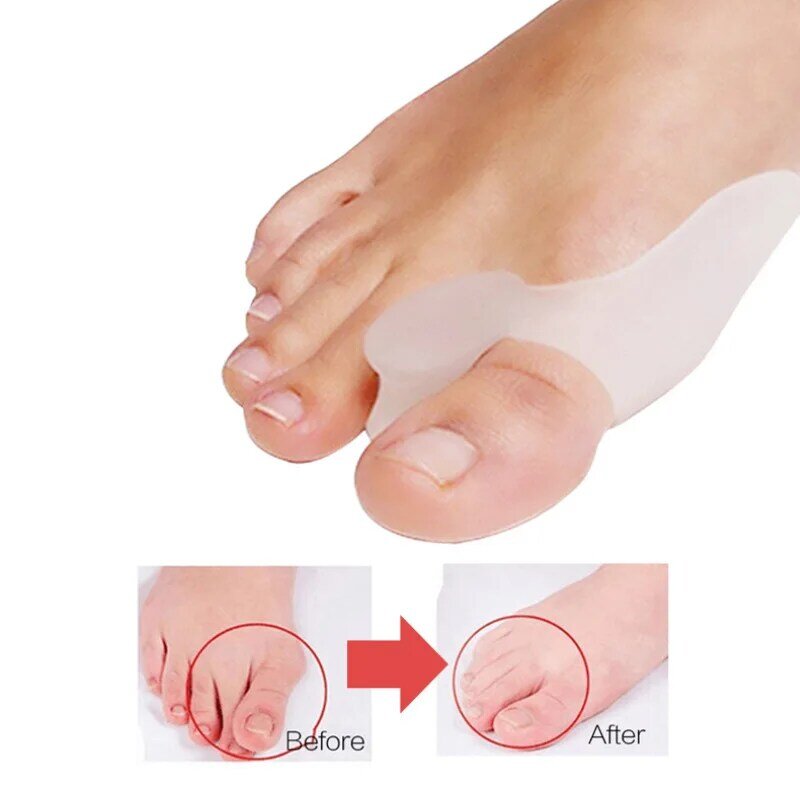 2 Stück Silikon gel Daumen Korrektor Bunion Fuß Zehen Hallux Valgus Protector Separator Finger Glätte isen Einsteller Fußpflege-Tool