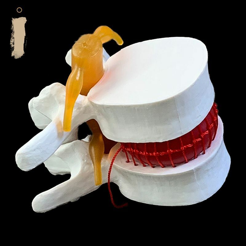 Modelo de demostración de hernia de disco Lumbar degenerativo, vértebras lumbares humanas anatómicas, modelo de columna vertebral humana, blanco, amarillo