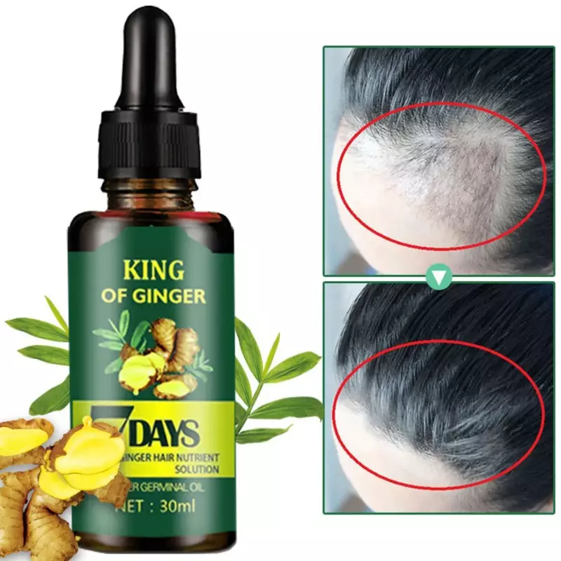 Aceite Esencial de jengibre para el cuidado del cabello, tratamiento para la pérdida del cabello, mejora el ambiente del cuero cabelludo durante 7 días, 30ml