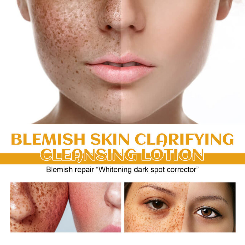 Losion Pembersih wajah menghilangkan bintik wajah, korektor Melanin pigmentasi dengan Pengontrol Minyak, menghilangkan bintik pori-pori, Losion Cuci wajah