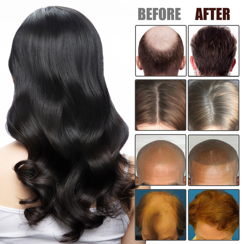 Aceite esencial para el crecimiento del cabello de romero, aceite para estimular los folículos, Anti calvicie, tratamiento efectivo del cuero cabelludo denso y aceitoso, adelgazamiento y engrosamiento