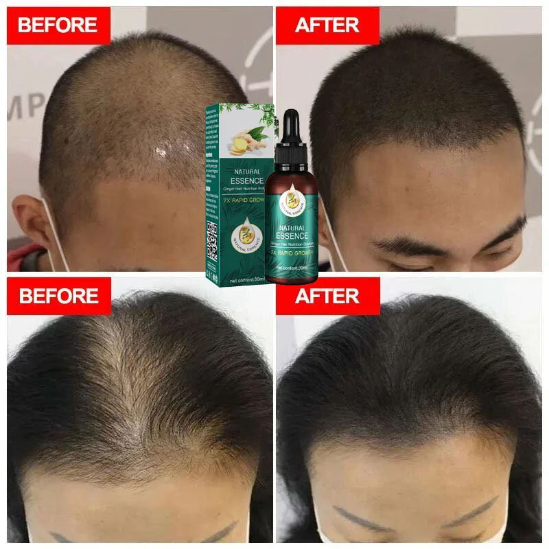 Óleo essencial para o crescimento rápido do cabelo, Produtos de crescimento do cabelo gengibre, Anti Hair Loss, Série 2024, Óleo essencial