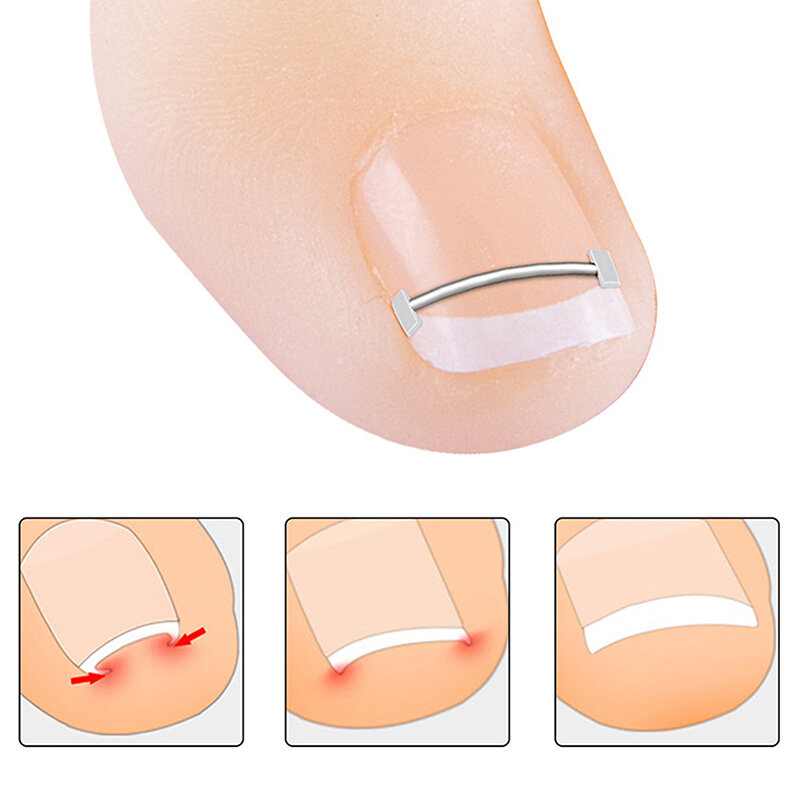 Корректор для вросшего ногтя инструмент для педикюра лечение для вросшего ногтя Профессиональный инструмент для выпрямления вросшего ногтя