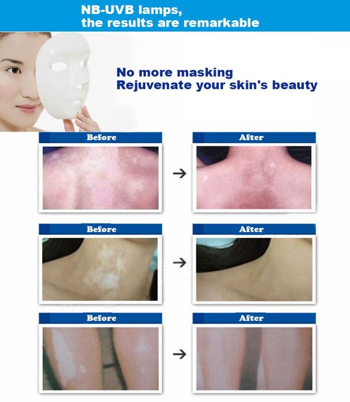Oryginalna fototerapia 311nm UVB na bielactwo, egzemę, łuszczycę, lampę UVB, lampę do leczenia problemów ze skórą