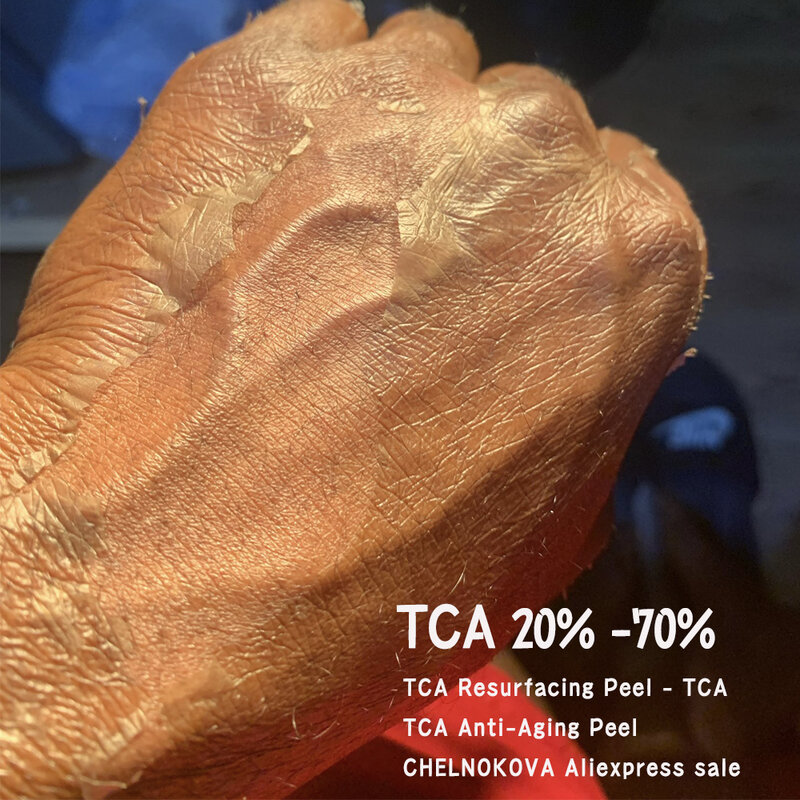 TCA 20 30 35 Hand Peel Results CHELNOKOVA Pigmentation Peel Aftercare Neutralization solution cooling cream