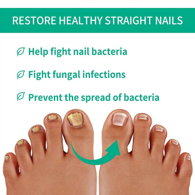Strong Nail Fungus Treatment Serum Essence piedi Removal Care Toe Serum infusion Anti Cream Repa Essence Nails fungino W7j4