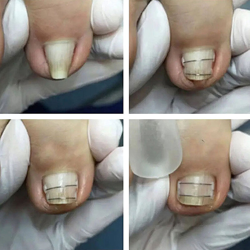 Ingrown Corrector unha para pedicure, Incorporar Toe Nail Treatment, Correção de unha engrown profissional, Pé Care Tool