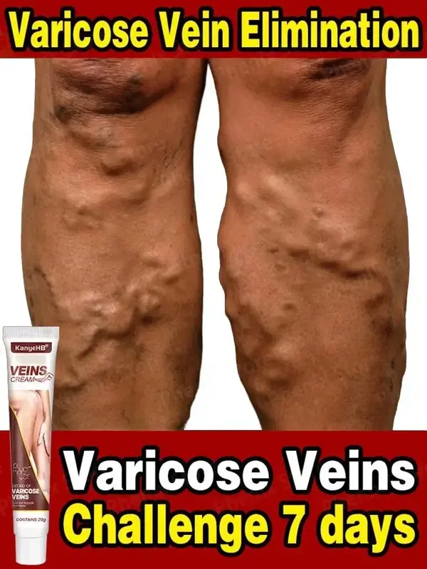 Effective Varicose Vein Relief Cream Eliminate Vasculitis Phlebitis Spider Legs Treatment Soothing Relieve Pain Herbal Ointment