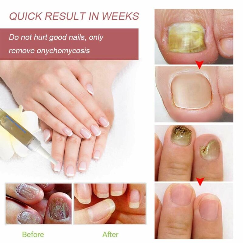 Tratamiento antihongos para uñas, solución líquida para el cuidado de la piel del dedo, reparador de pluma, aceite nutritivo que restaura la salud