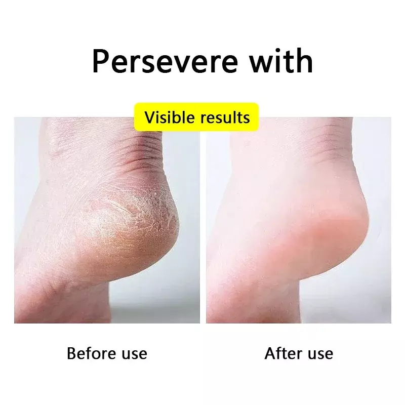 แผ่นรองซิลิโคน1คู่สำหรับให้ความชุ่มชื้นส้นเท้าถุงเท้าเปิดนิ้วเท้าส้นเท้าแตกซ่อมแซมส้นเท้าแห้งเท้าแตก