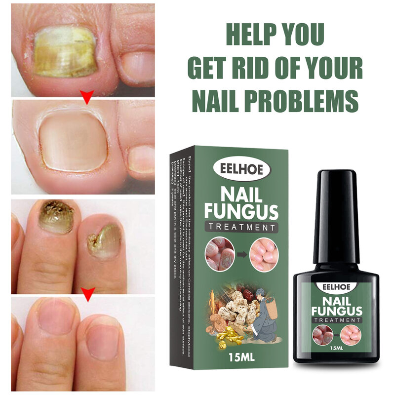 Nail Fungal Cure Nail Fungus Removal Liquid Nutritious Anti Paronychia Onychomycosis Foot Repair Fungal Nail Repair Wholesale