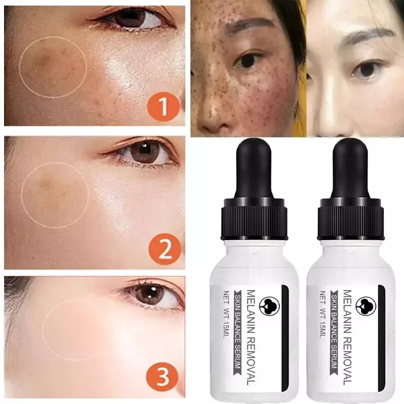 Dark Spots Remover Serum Freckle Whitening Moisture Effective Powerful Removal Black Dot Melasma Chloasma Face Skin Care Cream
