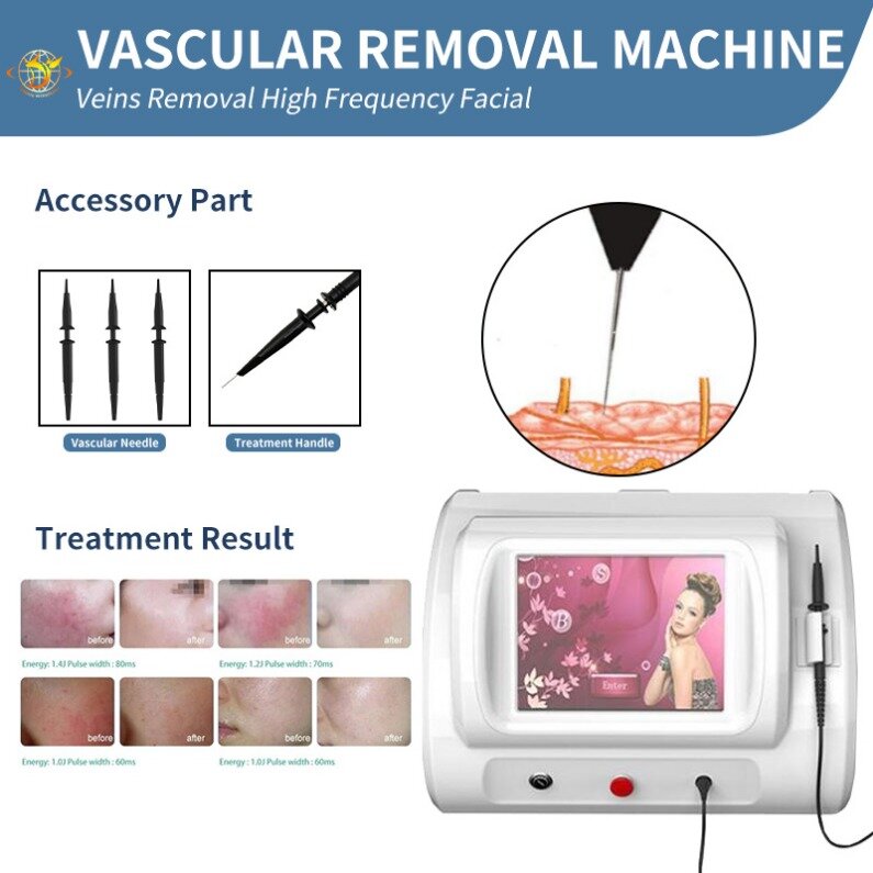 Beauty Equipment R-F Spider Vein Remove Machine E Spider Vein Removal Vascular Spot Removing R-F Beauty Machine Free Shipme