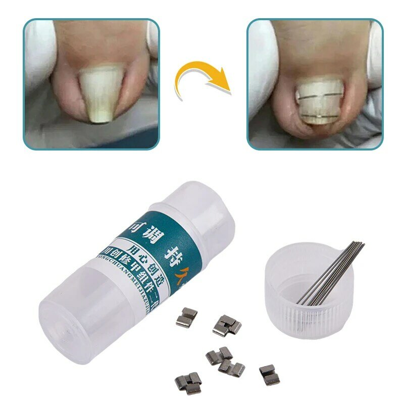 Corrector de uñas encarnadas, herramientas de pedicura, tratamiento profesional de uñas encarnadas, Clip alisador