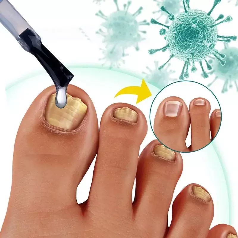 Antibacterial Liquid for Nail Fungus Nail Removal Cream Thickening Soft Nails Paronychia Treatment Beauty Health Feet Care Tools