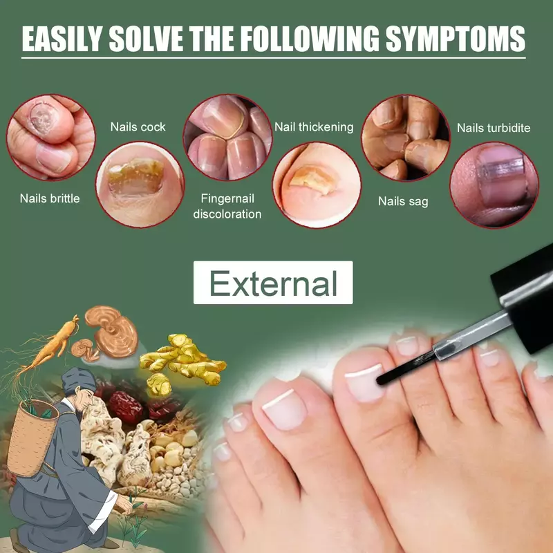 Aceite Esencial para tratamiento de hongos en las uñas, suero para la eliminación de hongos en los pies, 7 días de reparación, onicomicosi, Gel antiinfección, productos para el cuidado