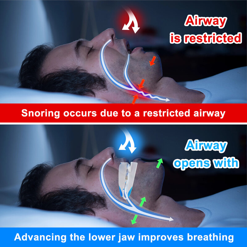 Ajustável Anti ronco protetor de boca, Anti-ronco bocal, dispositivos de dormir, bruxismo ronco rolha, melhorar o sono