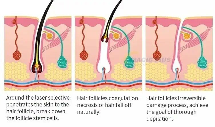 جهاز إزالة الوشم بليزر الصمام الثنائي بيكوسكوند ، إزالة الأصباغ ، إزالة الشعر بشكل دائم ، من من من من الشعر ، من من من 8000 نانومتر ، ،
