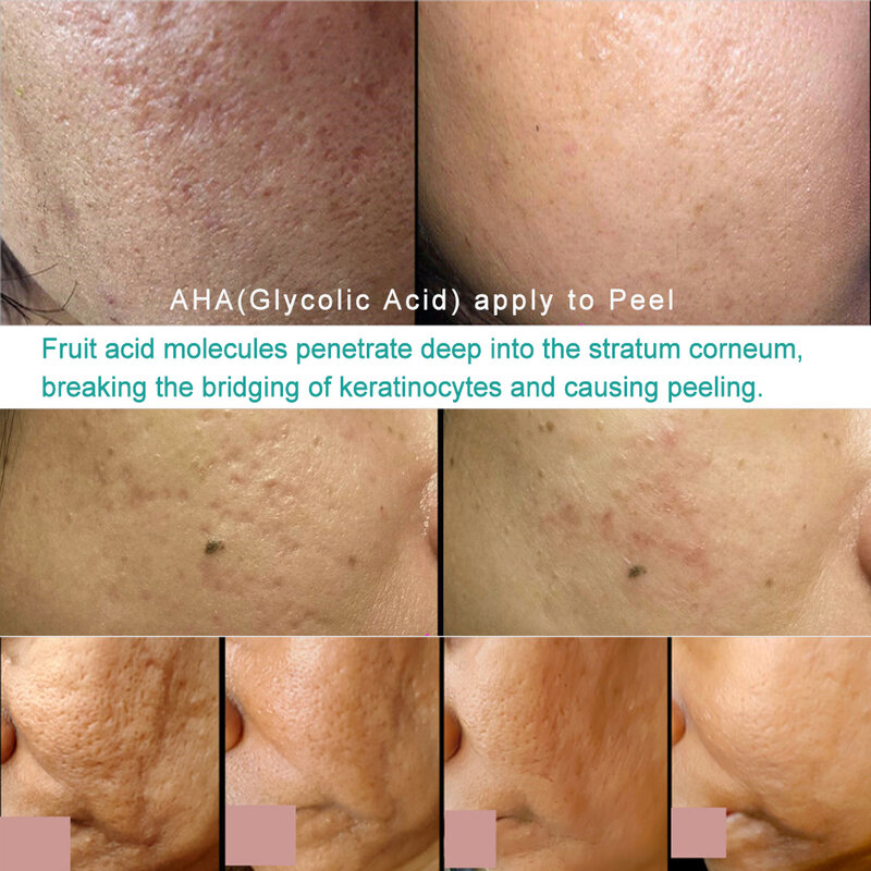 Alpha Hydroxy Acids (AHAs)  10pcs Glycolic Acid (GA) 30% 35% Acid peel Products for Dry Skin Oily Skin Scars AHA for Dark Spots