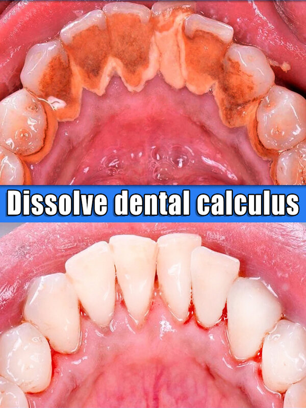 Disolución para eliminar el cálculo dental