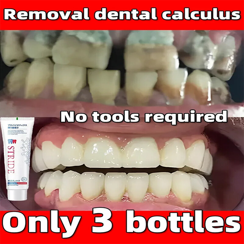 Eliminador de cálculo Dental, blanqueador de dientes, pasta de dientes, eliminación de olores bucales, mal aliento, eliminación de placa Dental, prevención de Periodontitis