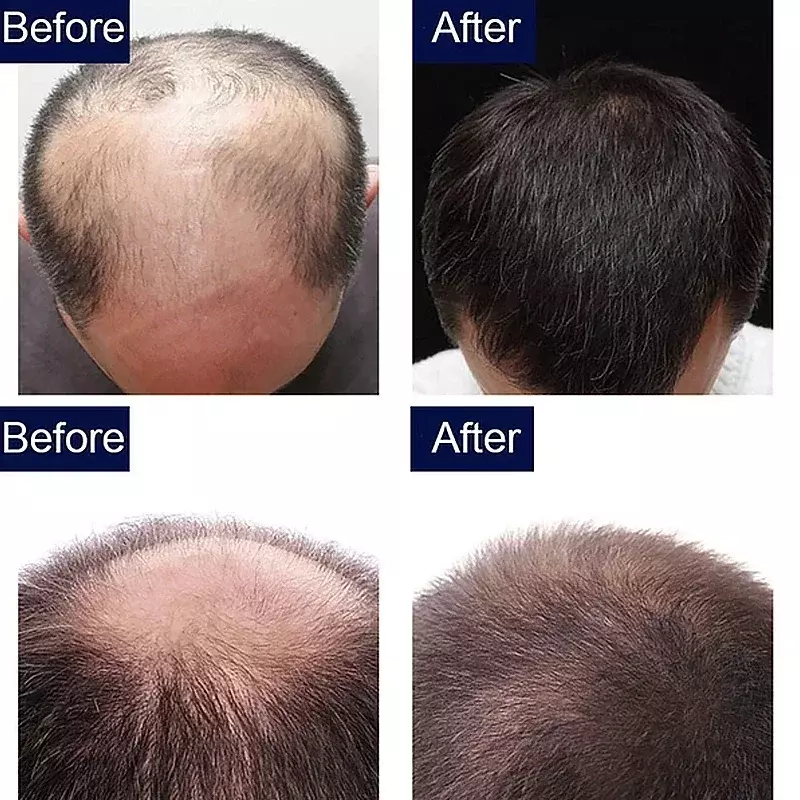 Óleo de crescimento de cabelo para homens e mulheres, crescimento rápido do cabelo, anti perda de cabelo, tratamento do couro cabeludo, produtos de soro, beleza, 2024