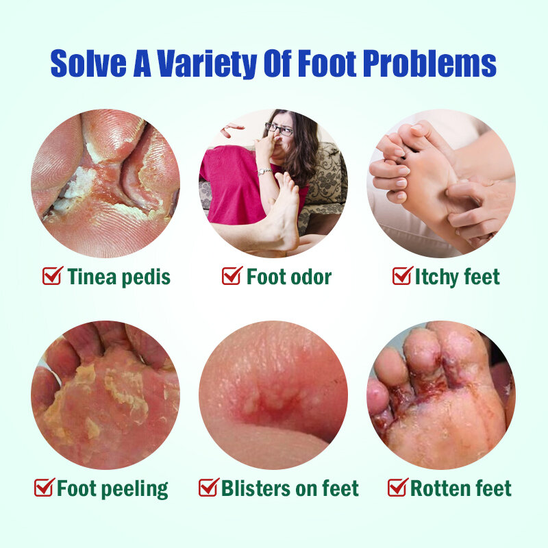 2pcs Beriberi Cream Foot psoriasi Cream menta Cool Anti Itch unguento per i piedi dell'atleta che inibisce i funghi riparano la pelle Peeling A941
