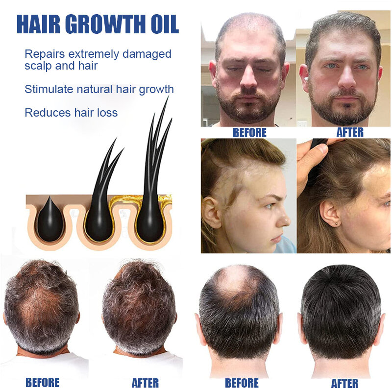 زيت أساسي لنمو الشعر ، زيت النمو السريع ، مضاد لتساقط الشعر الطبيعي ، إصلاح الشعر التالف ، علاج فروة الرأس ، الرعاية الصحية ، 32: