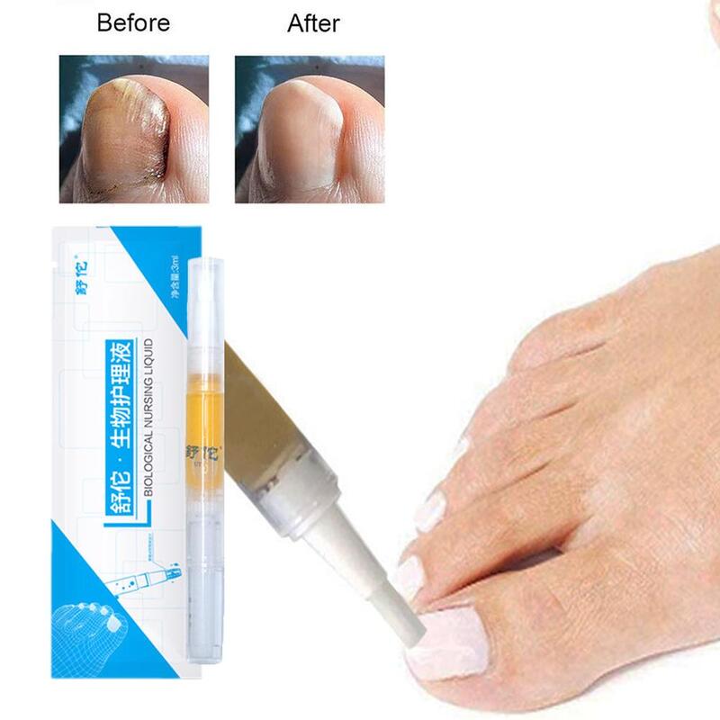 Laserowe wskaźnik paznokci bezbolesne pióro naprawcze paznokci z grzybem paznokci usunąć grzyb wskaźnik wskaźnik laserowy paznokci
