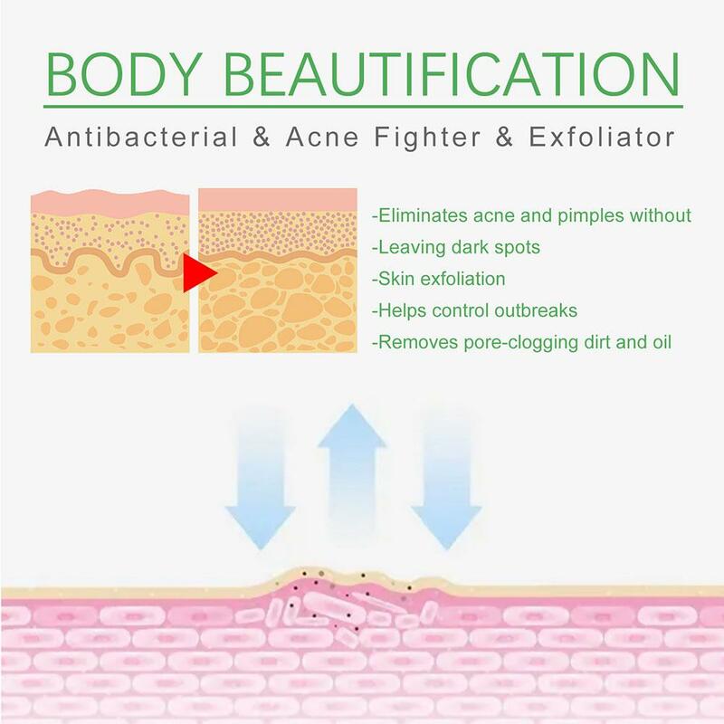 Sérum anti-acné aux herbes pour le visage, traitement des boutons, rétrécissement des pores, contrôle de l'huile, soins de la peau, 30ml