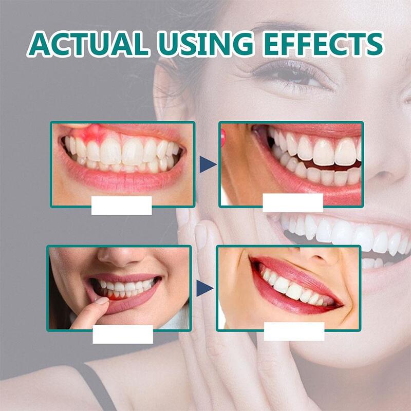 Gotas de crecimiento de encías para aliviar el dolor, tratamiento de sangrado de encías periodontales, antibacterias, cuidado de la limpieza bucal