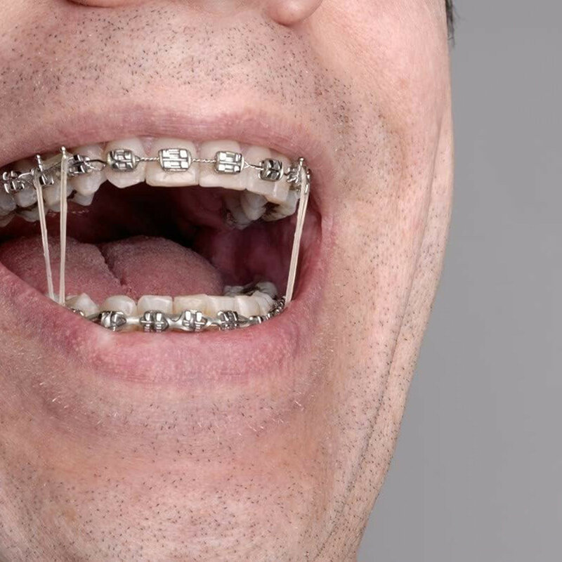 100 buah karet gelang untuk perawatan gigi elastik kawat gigi memperbaiki dekorasi 3.5 Oz 3/8