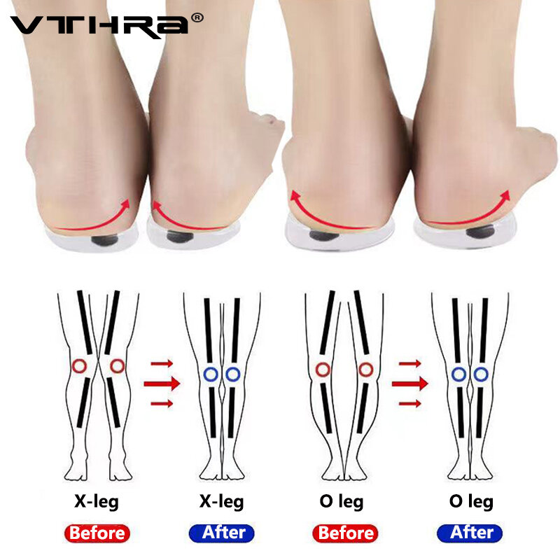 1 Pair Magnets Silicon Orthopedic Insoles Foot Care Tool For Men Women Health Care O/X Type Legs Knee Varus Correction Heel Pads