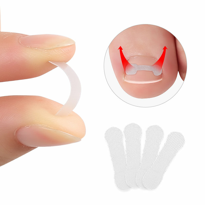 1 ~ 10 Stück 4-Nagel-Korrektur Aufkleber Paronychie ein gewachsene Zehen nagel Korrektur elastische Glättung Clip Klammer Pediküre
