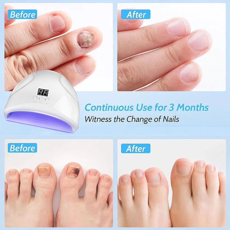 Dispositivo láser para uñas fungicida, reparación rápida y efectiva de hongos en las uñas de los pies, tratamiento de esencia antiinfección, onicomicosis láser